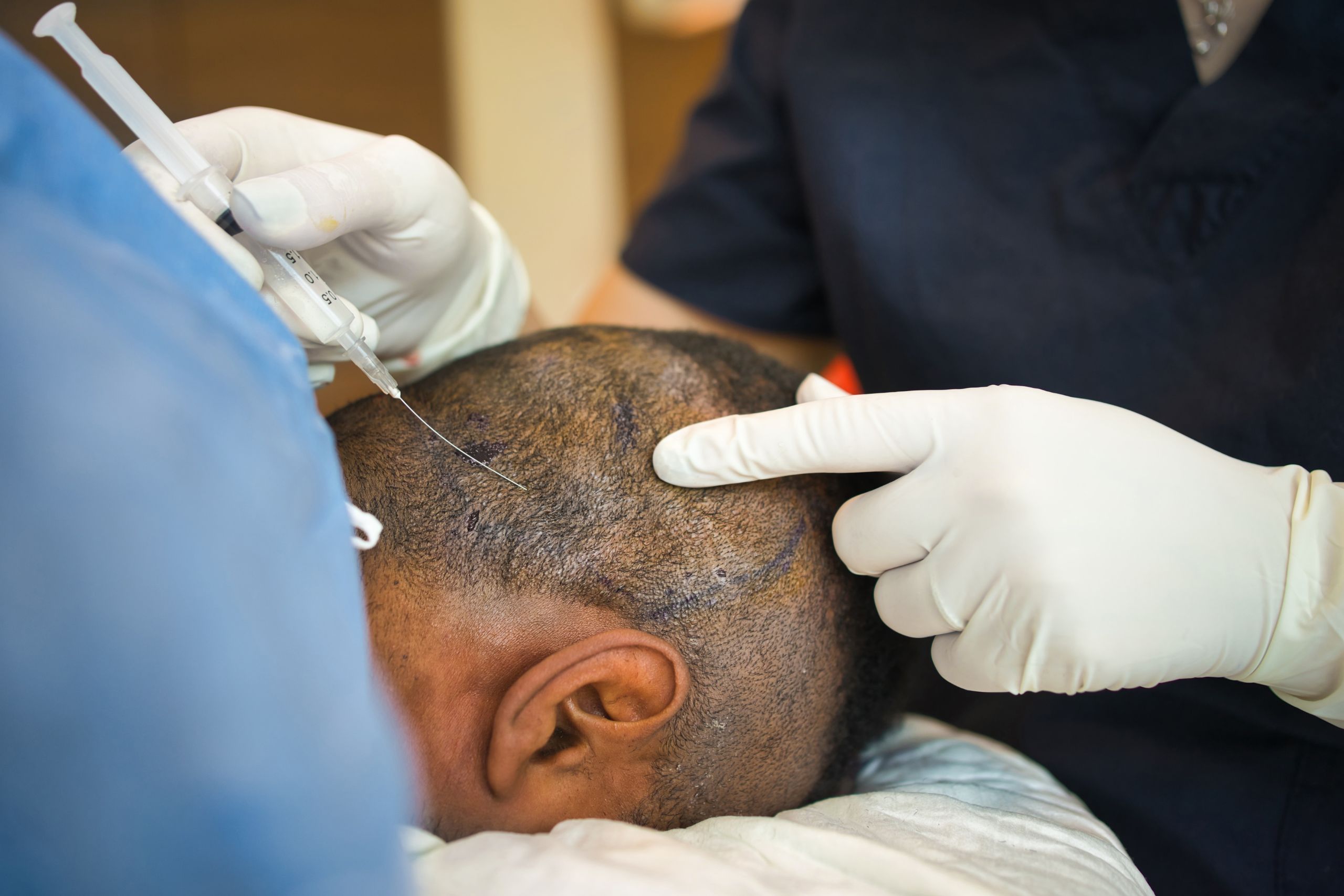 Hair Transplant Prices and Service in Turkey